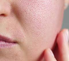 Open Enlarged Pores