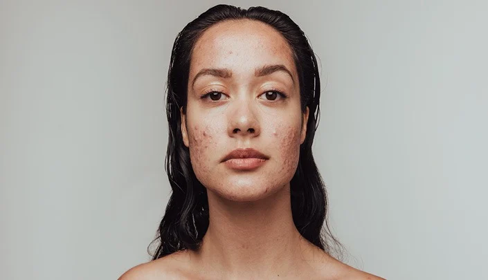 Acne Scars Removal