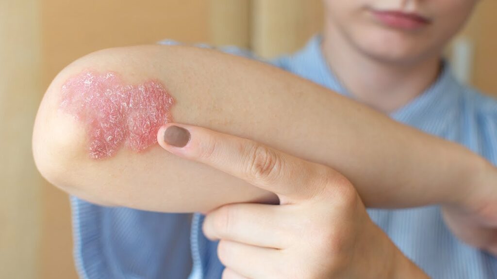 Skin Psoriasis Treatment