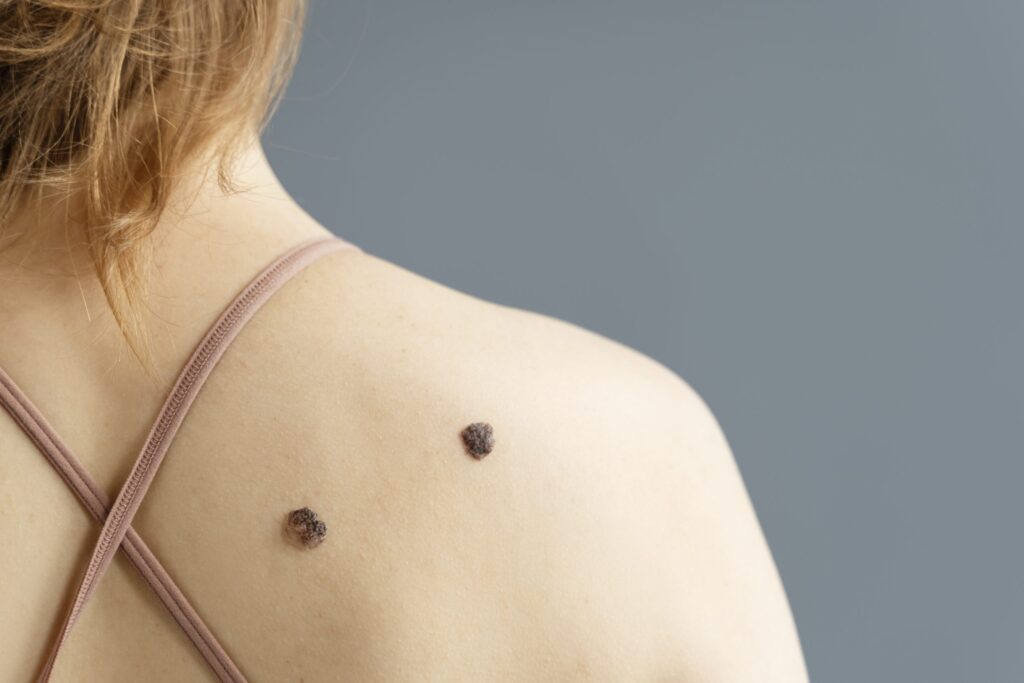 Skin Mole Mapping in Abu Dhabi