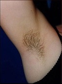laser-hair-removal-before-after