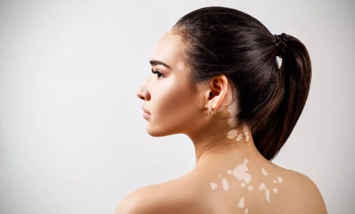 Vitiligo Laser Therapy